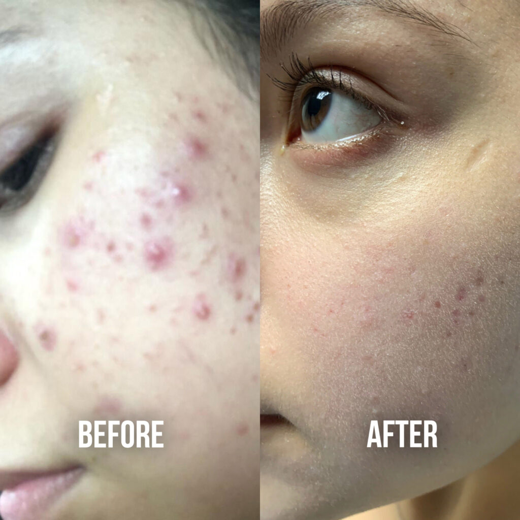acne treatments suwanee ga, acne treatments before after