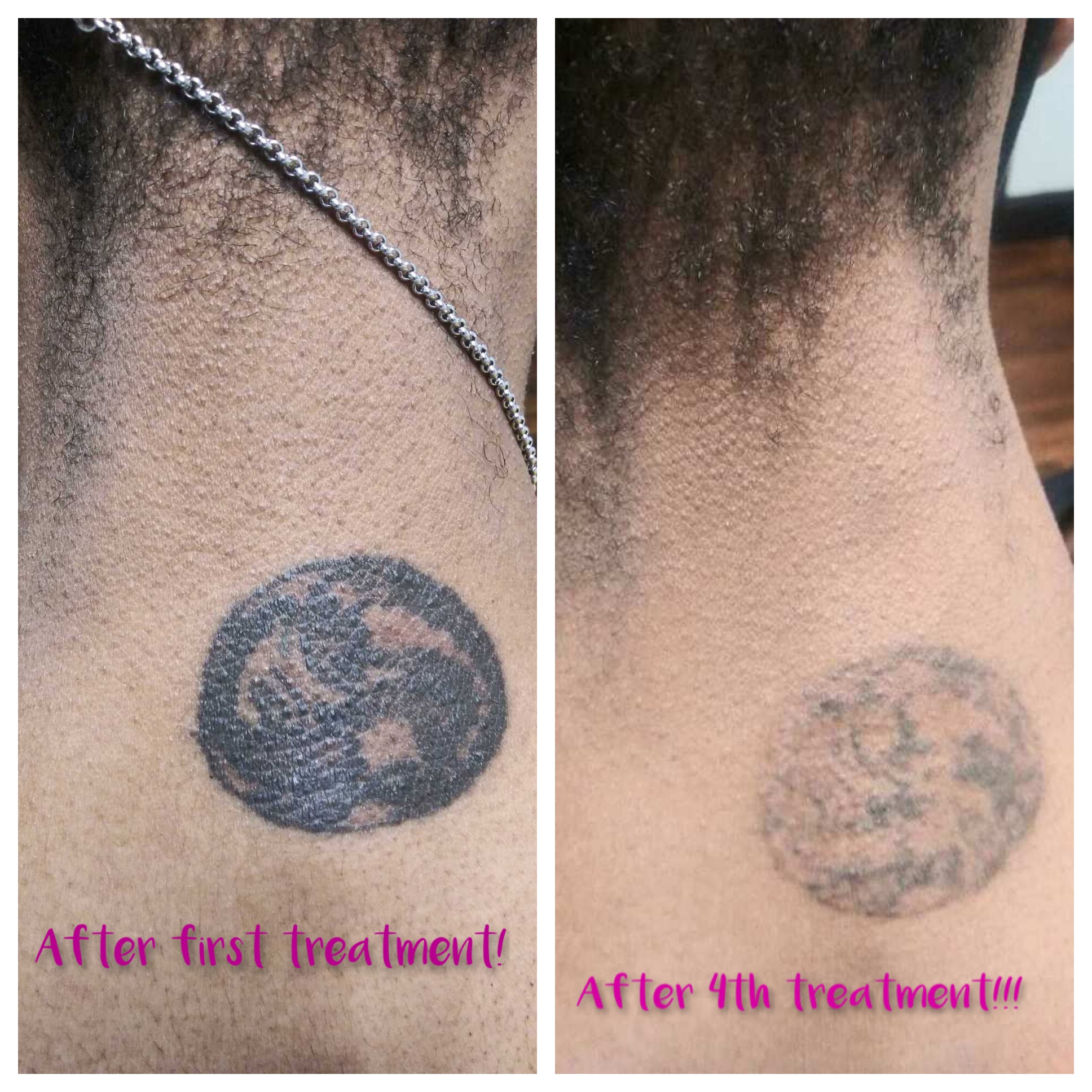 Enlighten Laser Tattoo Removal
