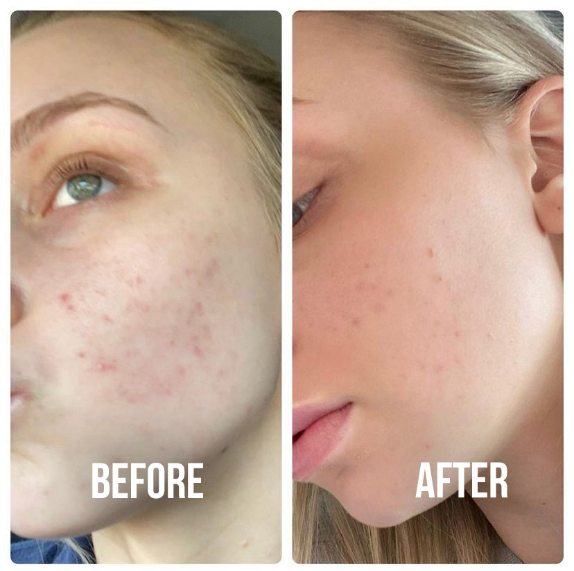 acne treatments suwanee ga, acne treatments before after