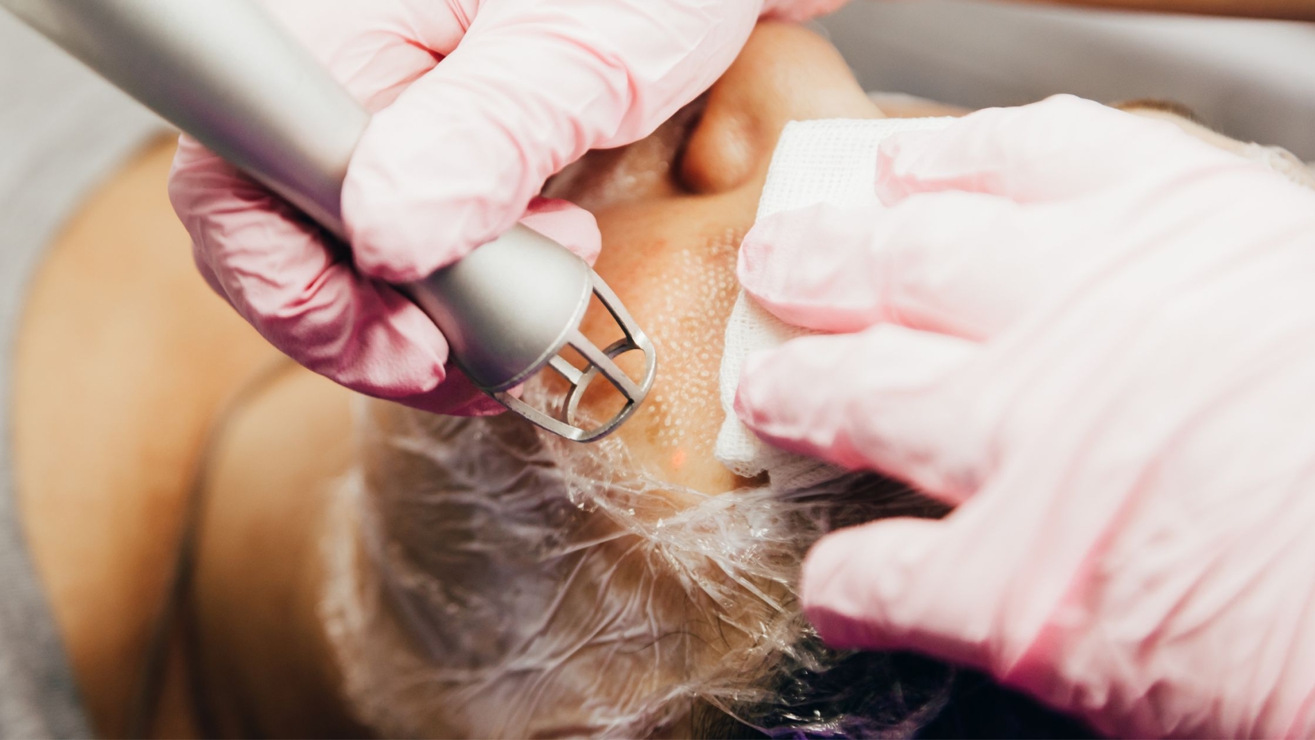 co2 laser treatments near me