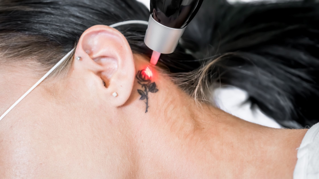 laser tattoo removal suwanne ga