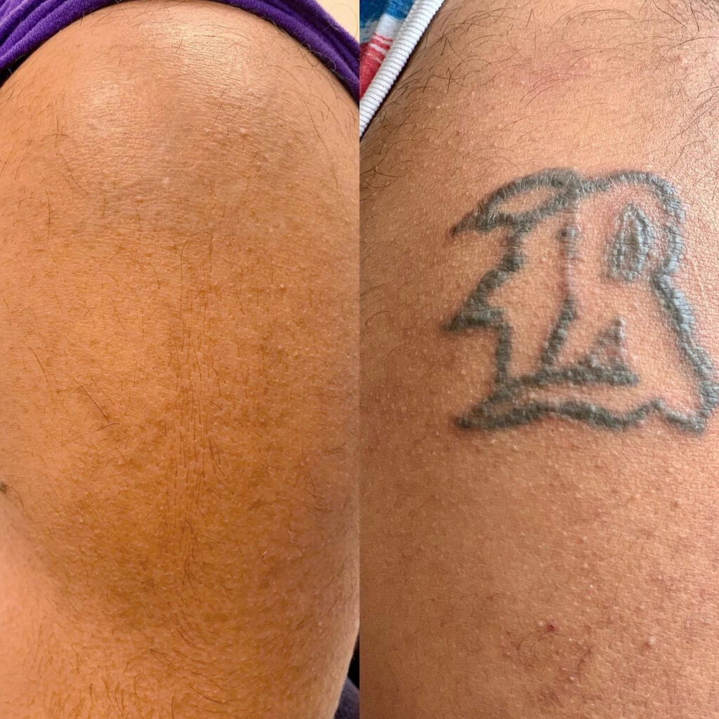 tattoo removal Suwanee